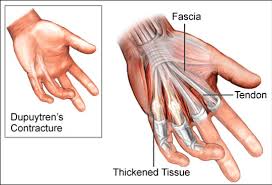 Dupuytren'S Contracture, Image Credit: Https://Www.ntxortho.com/Speciality-Condition/Dupuytrens-Contracture-Of-The-Hand/