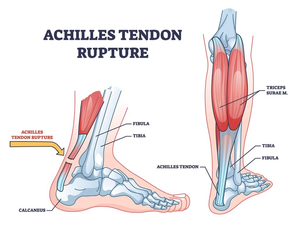 Achilles Tendon Rupture, Image Credit: Https://Scmsc.com/Podiatry/Podiatry-Conditions-Treated/Achilles-Tendon-Rupture/