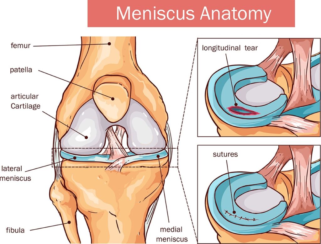 Meniscus, Image Credit: Https://Spireortho.com.sg/Medical-Conditions/Meniscus-Tear/