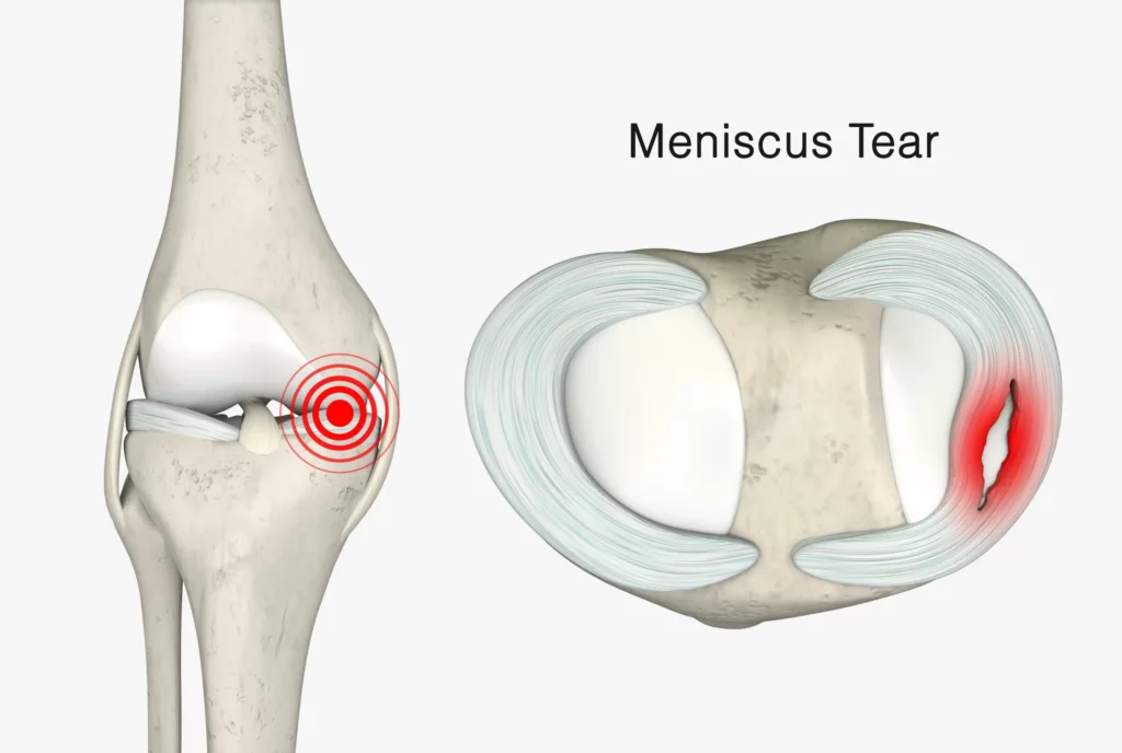 Meniscus Tear, Image Credit: Https://Www.qoctor.com.au/Meniscus-Tear/