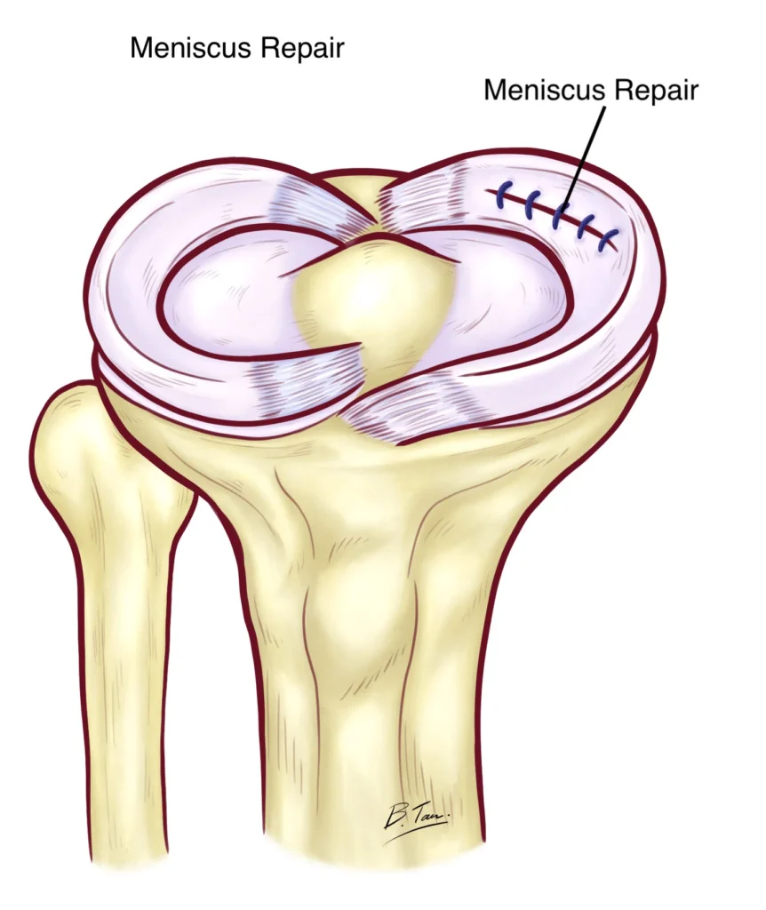 Meniscus Repair, Image Credit: Https://Www.drbryantan.com/Knee-Specialist-Singapore/Meniscus-Tear/
