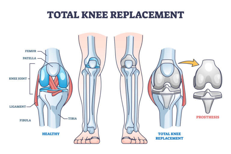 What Is A Total Knee Replacement? Understanding Knee Replacement Surgery 2 Total Knee Replacement, Image Credit: Https://Www.ctortho.com/2023/01/06/Total-Knee-Replacement-What-Are-The-Benefits-And-Risks/