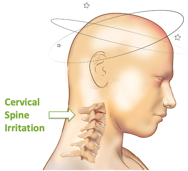 Targeted Myofascial Release For Cervicogenic Vertigo: A Case Perspective On The Levator Scapulae And Cervical Fascial Chain 1 Cervicogenic Vertigo