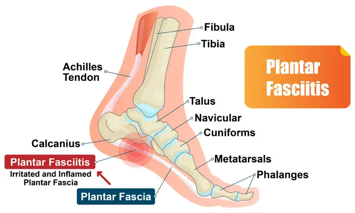 Why Does Plantar Fasciitis Become Chronic? Understanding Persistent Heel Pain 1 Plantar Fasciitis, Image Credit: Https://Www.mountelizabeth.com.sg/Health-Plus/Article/Common-Conditions-Heel-Pain