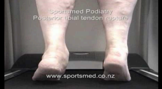 The Heel Raise Test