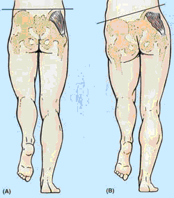 Do Your Hips Drop When You Walk Or Run? Exercises To Improve Hip Stability 1 Hip Drop, Image Credit: Https://Runnersconnect.net/Hip-Strength-And-Running-Form-The-Role-Of-Hip-Drop-In-Running-Injuries/