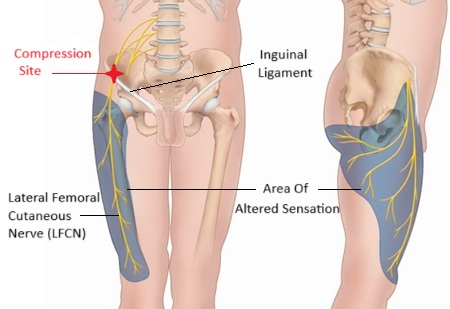Lateral Femoral Cutaneous Nerve