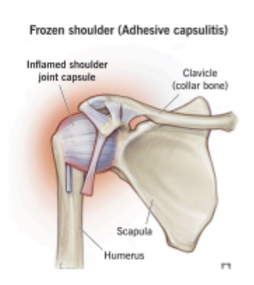 Adhesive Capsulitis