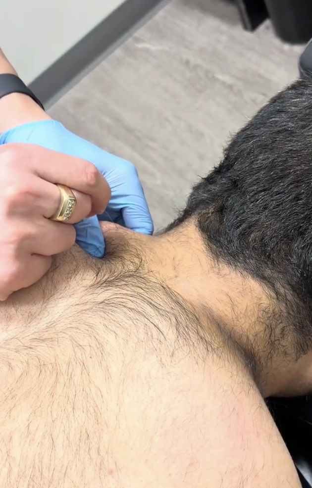 Dry Needling