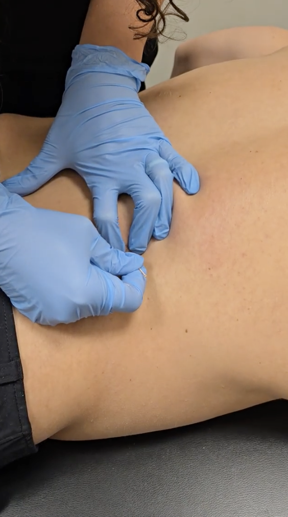 Dry Needling For Low Back Pain | Physiotherapy Treatment 2 How May Dry Needling Help With Low Back Pain?