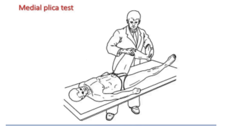 Medial Plica Syndrome: What It Is, How To Tell It Apart From A Medial Meniscus Tear, And How To Rehab It 2 Mediopatellar Plica Test Or Hughston'S Plica Test