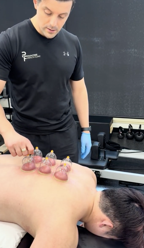 Static Vs. Dynamic Cupping Therapy | Which Cupping Technique Is Right For You? 1 Static Cupping