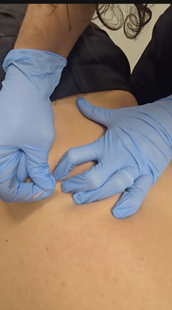 Dry Needling For Low Back Pain | Physiotherapy Treatment 1 What Is Dry Needling?
