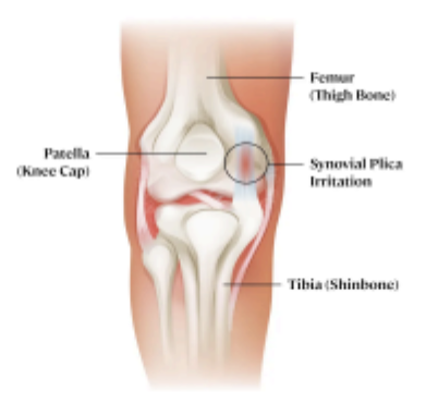 Medial Plica Syndrome: What It Is, How To Tell It Apart From A Medial Meniscus Tear, And How To Rehab It 1 What The Medial Plica Actually Is