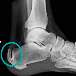 X-Ray Of A Patient With A Large Insertional Achilles Spur And Haglund'S Deformity In Front Of The Spur