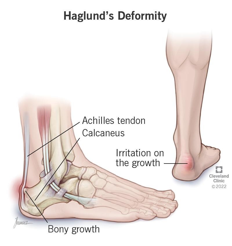Haglund'S Deformity, Image Credit: Https://My.clevelandclinic.org/Health/Diseases/25134-Haglunds-Deformity