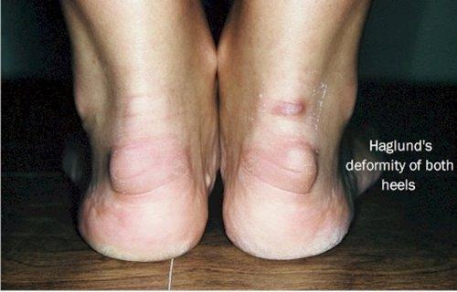 Common Symptoms, Image Credit: Https://Www.myfootshop.com/Blogs/Blog/Differentiate-Haglunds-Deformity-From-Achilles-Tendonitis?Srsltid=Afmboor6Bycokssg_1Hfmmr3Wt7Pynxbz7Rrk5S2Nfnnu5Glwv4Z0Wh0L