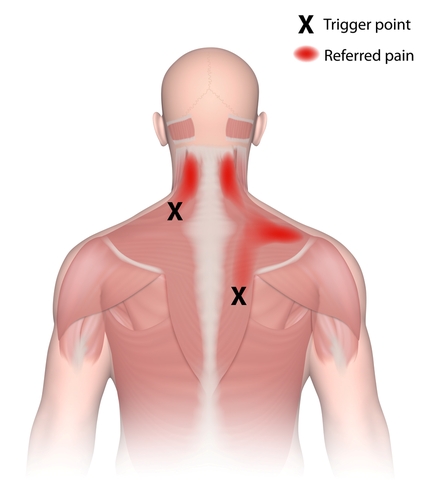 Myofascial Trigger Point, Image Credit: Https://Fieldsfamilychiro.com/Massage-Therapy/Trigger-Point-Therapy/