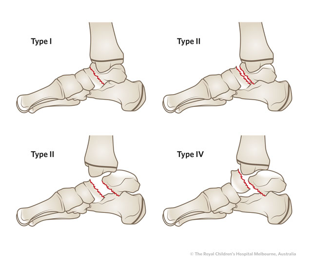 Ankle Fracture Rehab: Why Your Hip &Amp; Knee Matter Too 1 Talus Fracture, Image Credit: Https://Www.rch.org.au/Clinicalguide/Guideline_Index/Fractures/Talus_Fractures__Emergency_Department/
