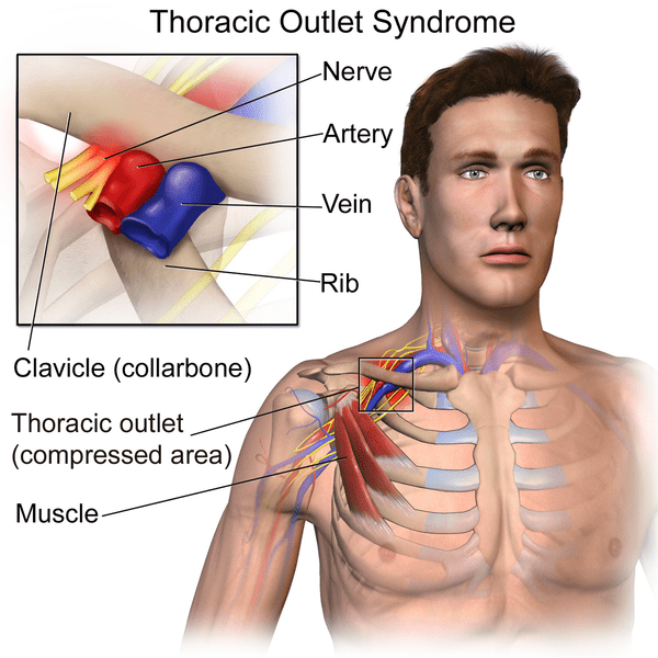 Thoracic Outlet Syndrome: Neck, Shoulder &Amp; Arm Symptoms 1 Thoracic Outlet Syndrome, Image Credit: Https://Www.physiotutors.com/Conditions/Thoracic-Outlet-Syndrome/