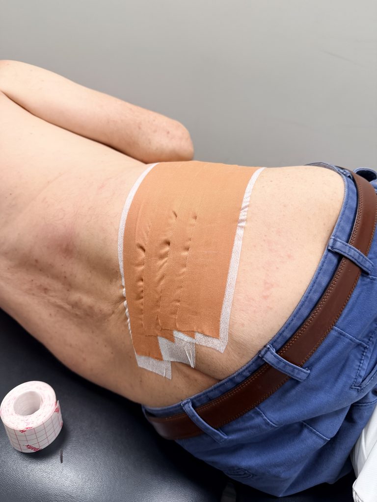 Why Do Physiotherapists Use Taping For Low Back Pain?